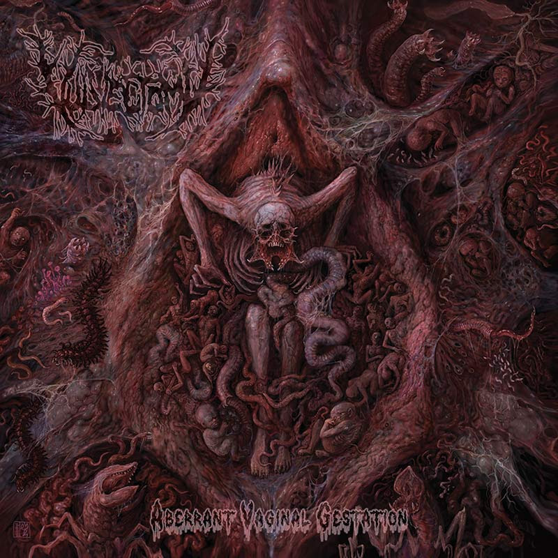 vulvectomy aberrant vaginal gestation